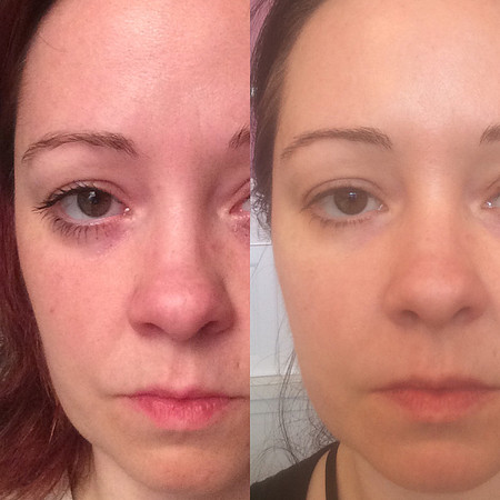 Before/After 3 Months